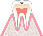 エナメル質の
虫歯