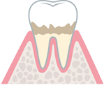 歯と歯茎（歯肉）の間に汚れが溜まる