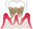 歯の土台（歯槽骨）を
                  溶かす